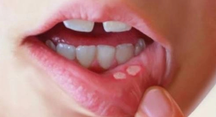 मुँह व जीभ के छाले दूर करने के उपाय ,Tongue Ulcer ,Muh Ke Chhale Home Remedies In Hindi, Munh Ke Chhale, Muh Par Chhale, Chhale Kaise Thik Kare