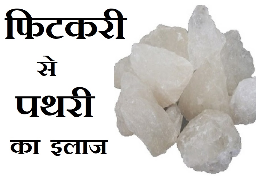 फिटकरी से पथरी का इलाज Fitkari Se Pathri ka ilaj, Fitkari kya hai, pathri kya hai, pathri ka ilaj fitkari se, Kidney Stone Symptoms in Hindi